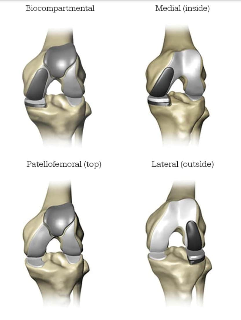 Mako Partial Knee replacement implants: top left is biocompartmental, top right is medial (inside), bottom left is patellofemoral (top), bottom right is lateral (outside)