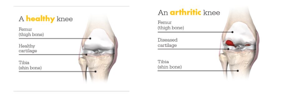 Mako graphic: left is an image of a healthy knee including femur, cartilage, and tibia; right is an arthritic knee including femur, diseased cartilage, and tibia